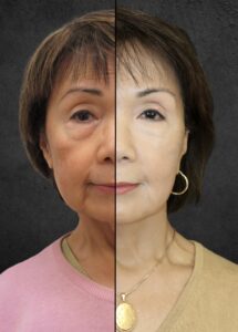 Rebecca Bautista Facelift consultation