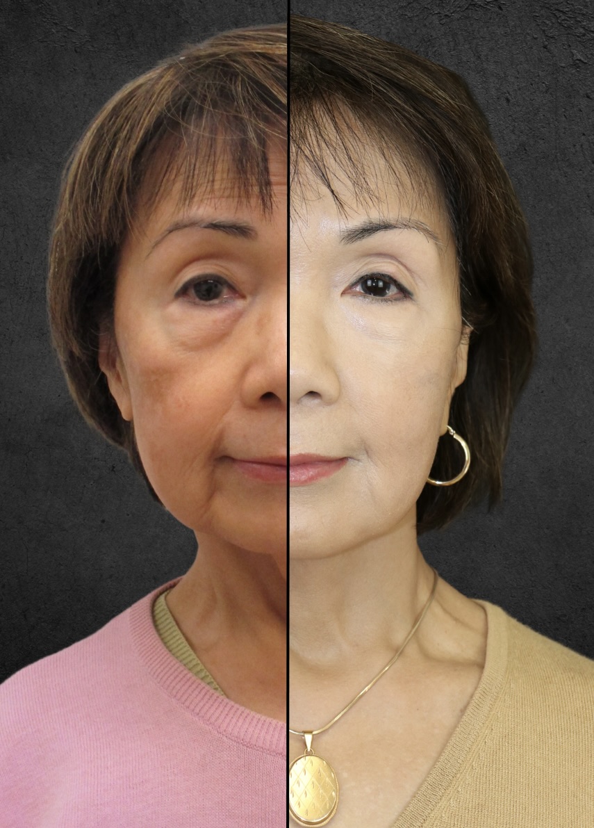 Have You Scheduled An Imagelift™ Facelift Consultation | Dr. Castellano ...