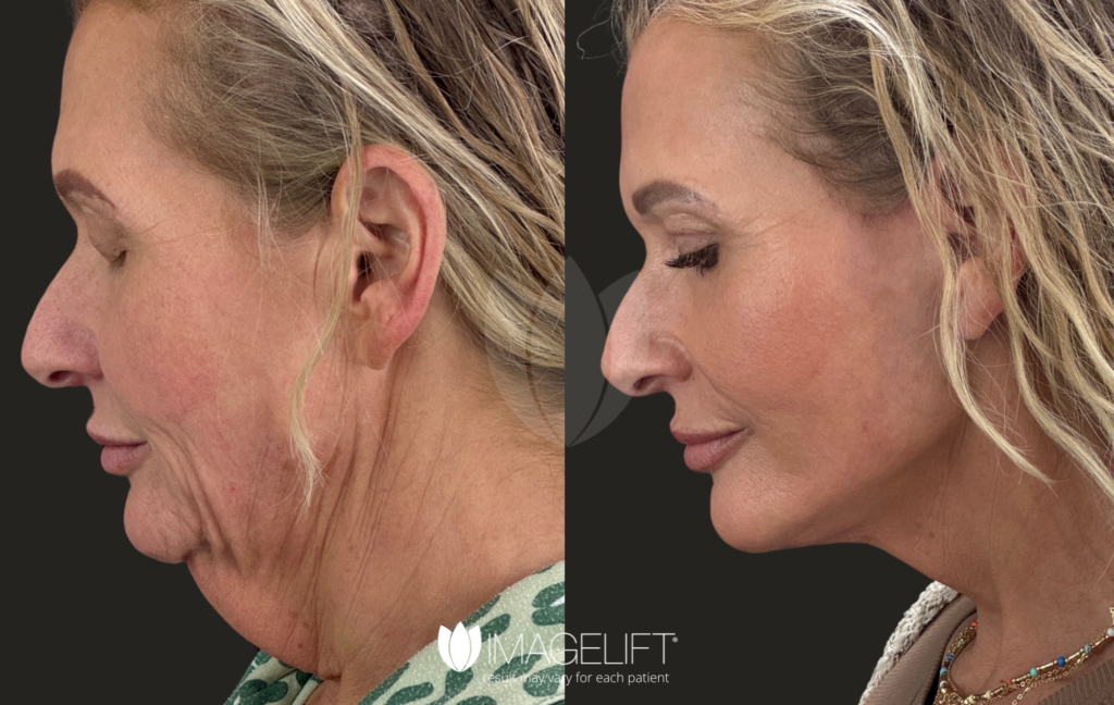 Amber Ramirez [3 WEEK FU]- Dr.Johnson, IL wLL, UB, Versa x 1, Dysport x 50u (3 weeks follow up)