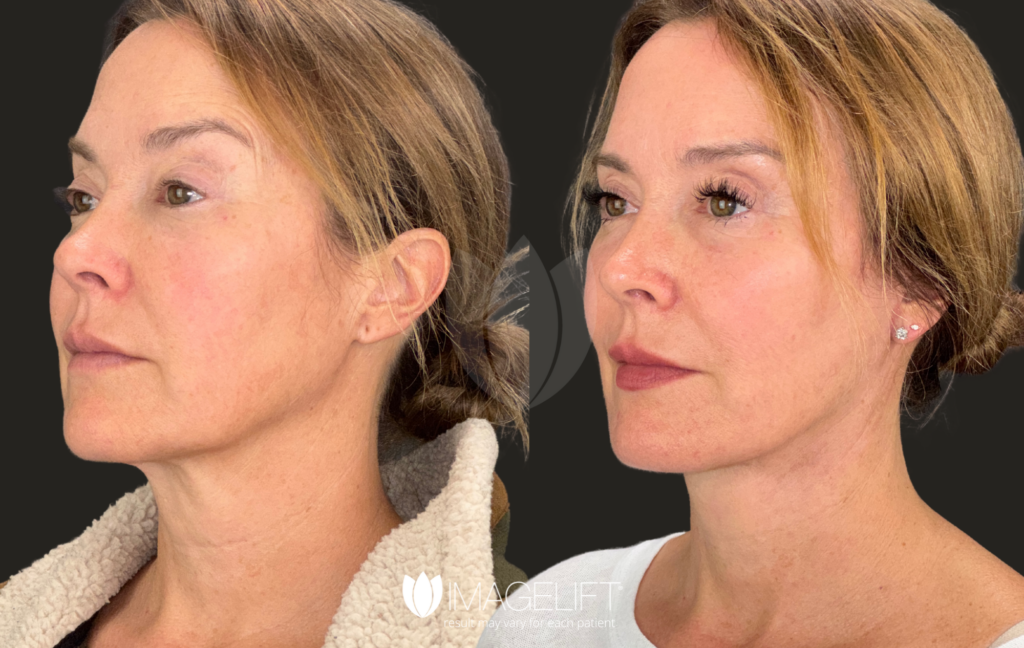Amber Serena - Dr.Rich - Deep Lift, Hyluronidase, sculptra, Jeuveau, Baby Co2