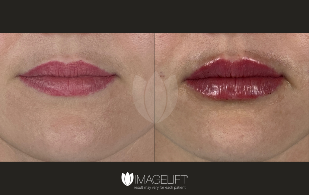 Copy of Copy of Jennifer Gold, PA-C _ Master Injector, Kayla Woody - Lip filler - versa, jeaveau (2)