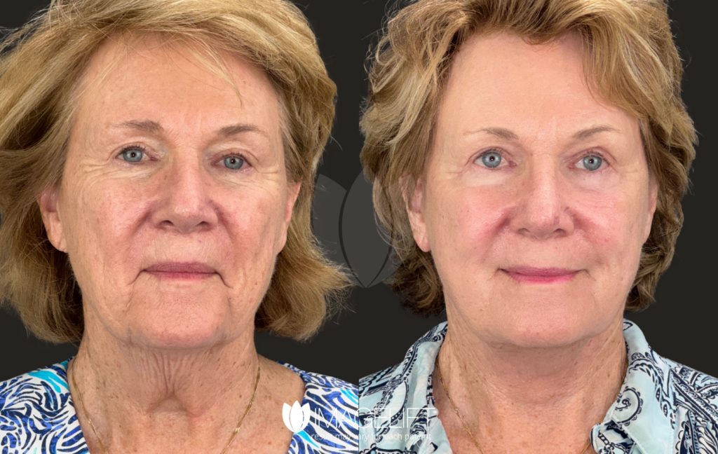 Copy of Nancy Kowalsk [2MTH PO] - Dr.Rich - IL w_LL, Co2 FF