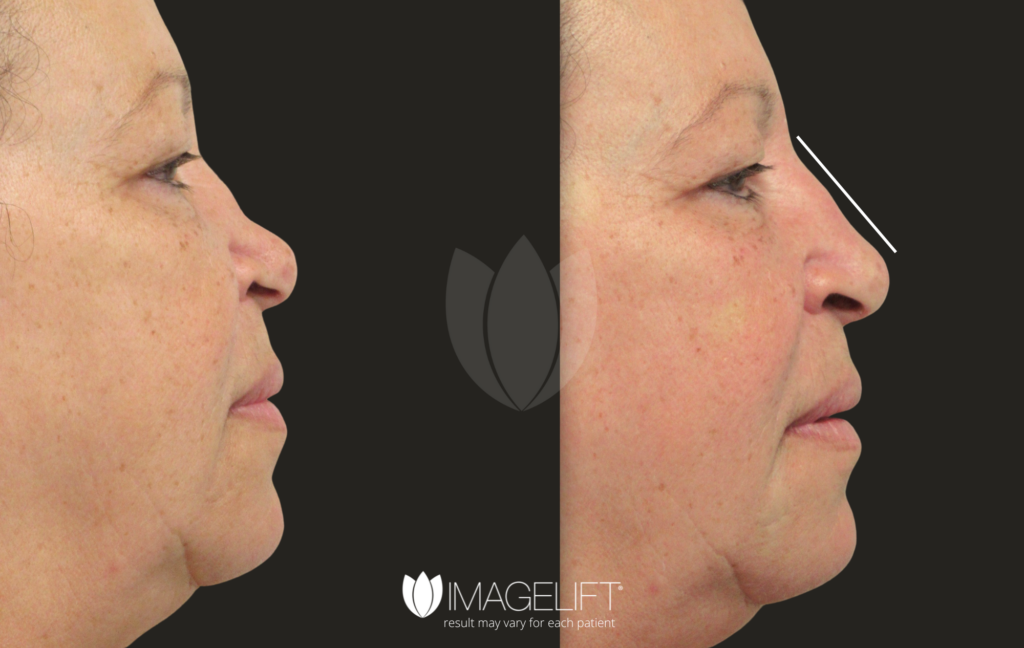 Filler Rhinoplasty