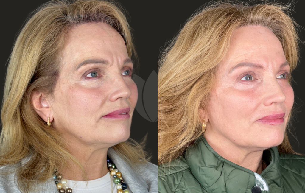 Kelly Harmon - Jenn G. - Clearlift laser, versa, restylane, jeaveau