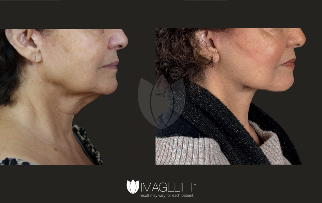 Parvin Roohi - Dr.Rich - MidLift w_LL, sculptra, vera, restyling silk, facial