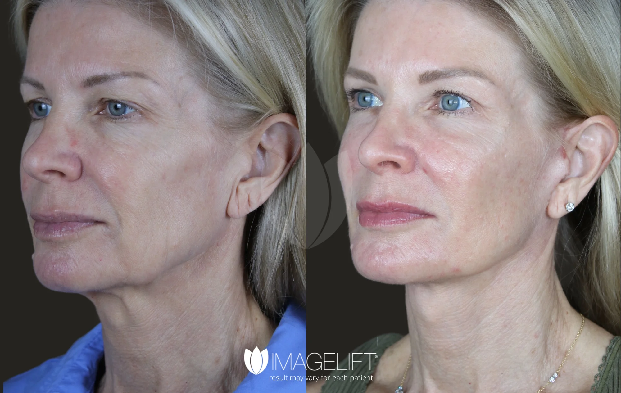 DeepLift Patient 8