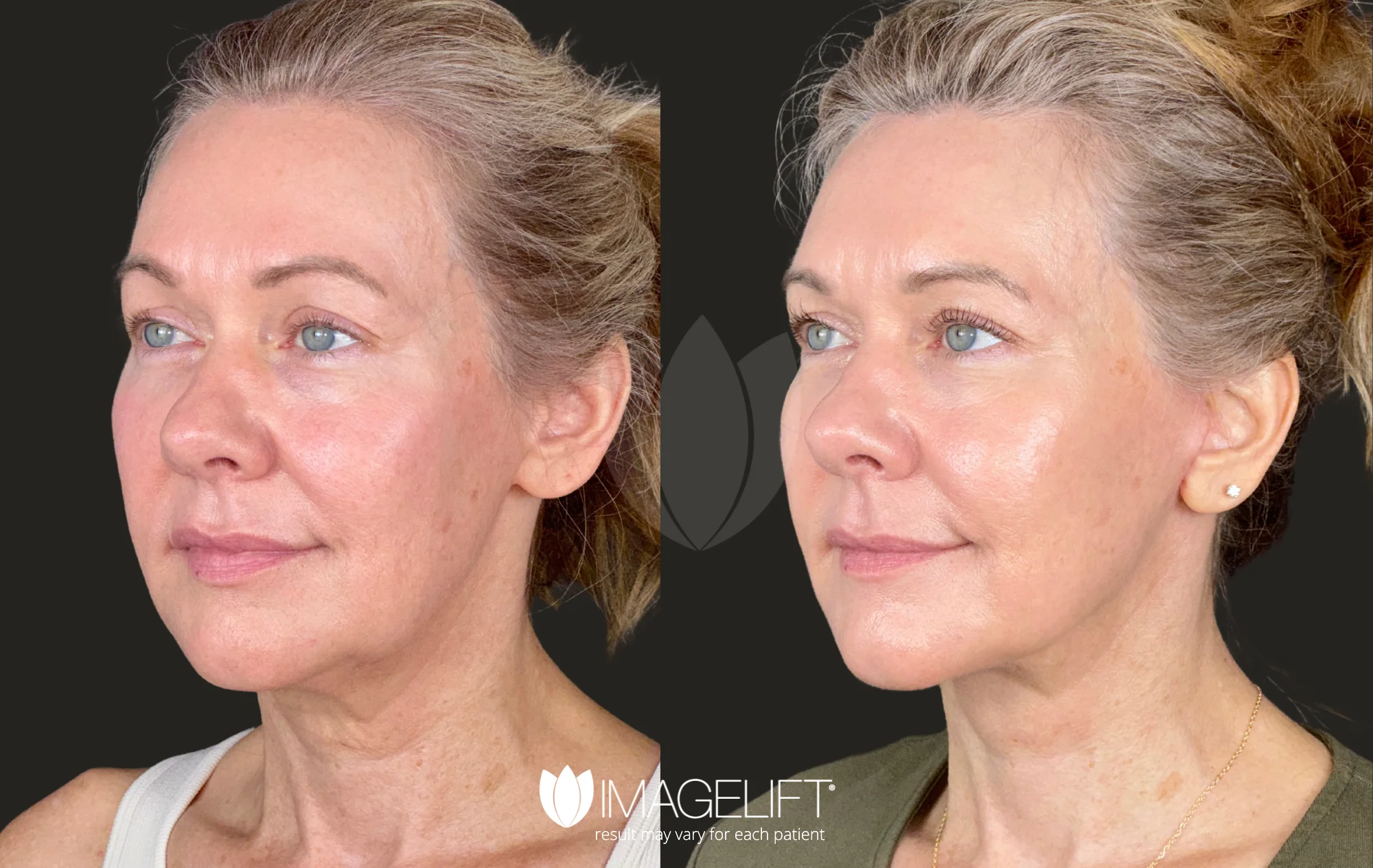 DeepLift Patient 7