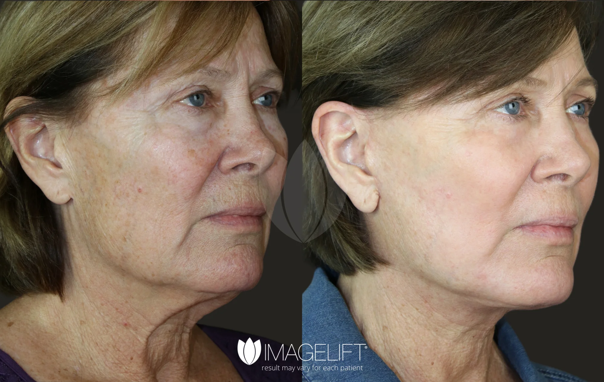 ImageLift Patient 14