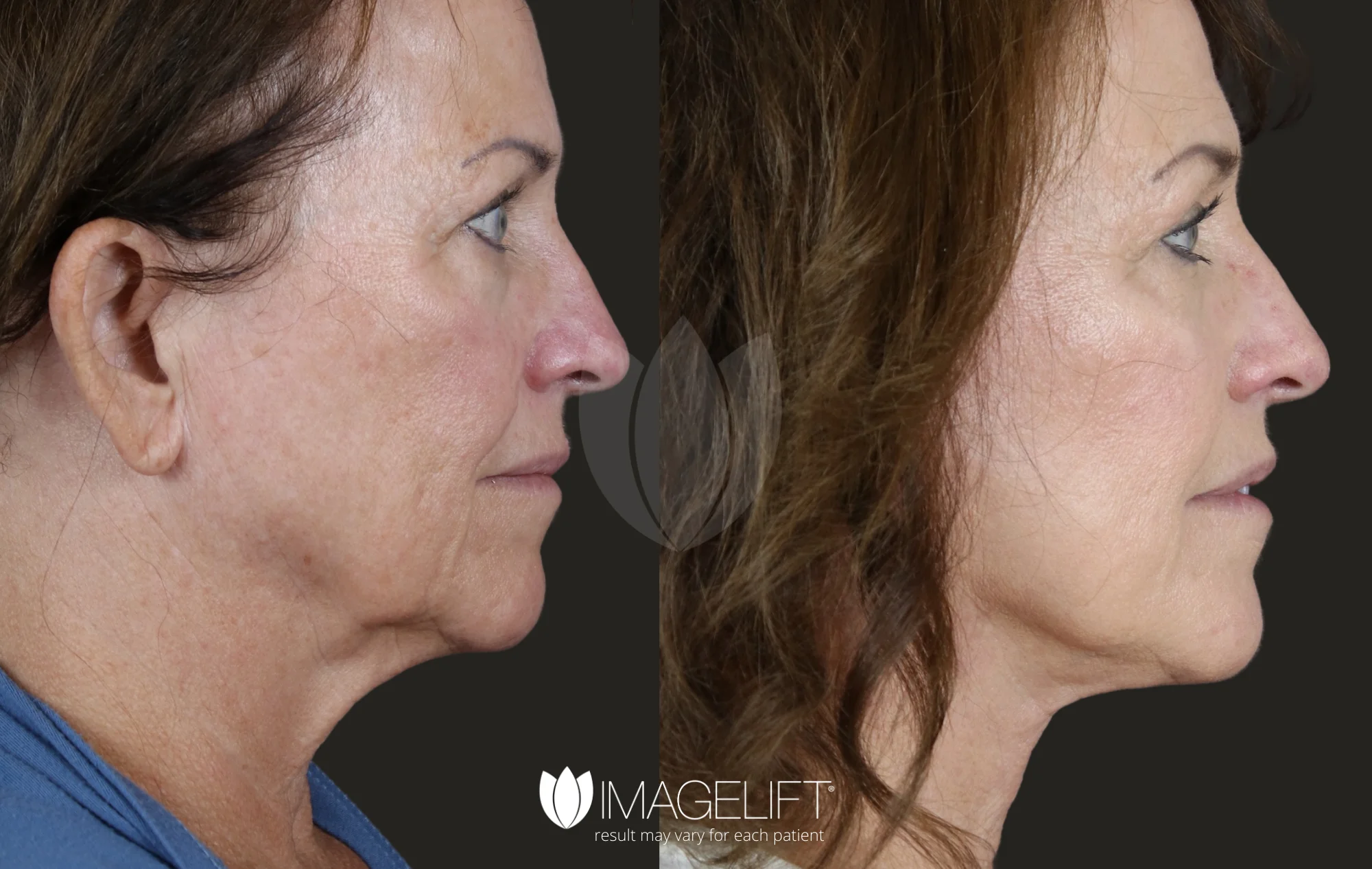 ImageLift Patient 18