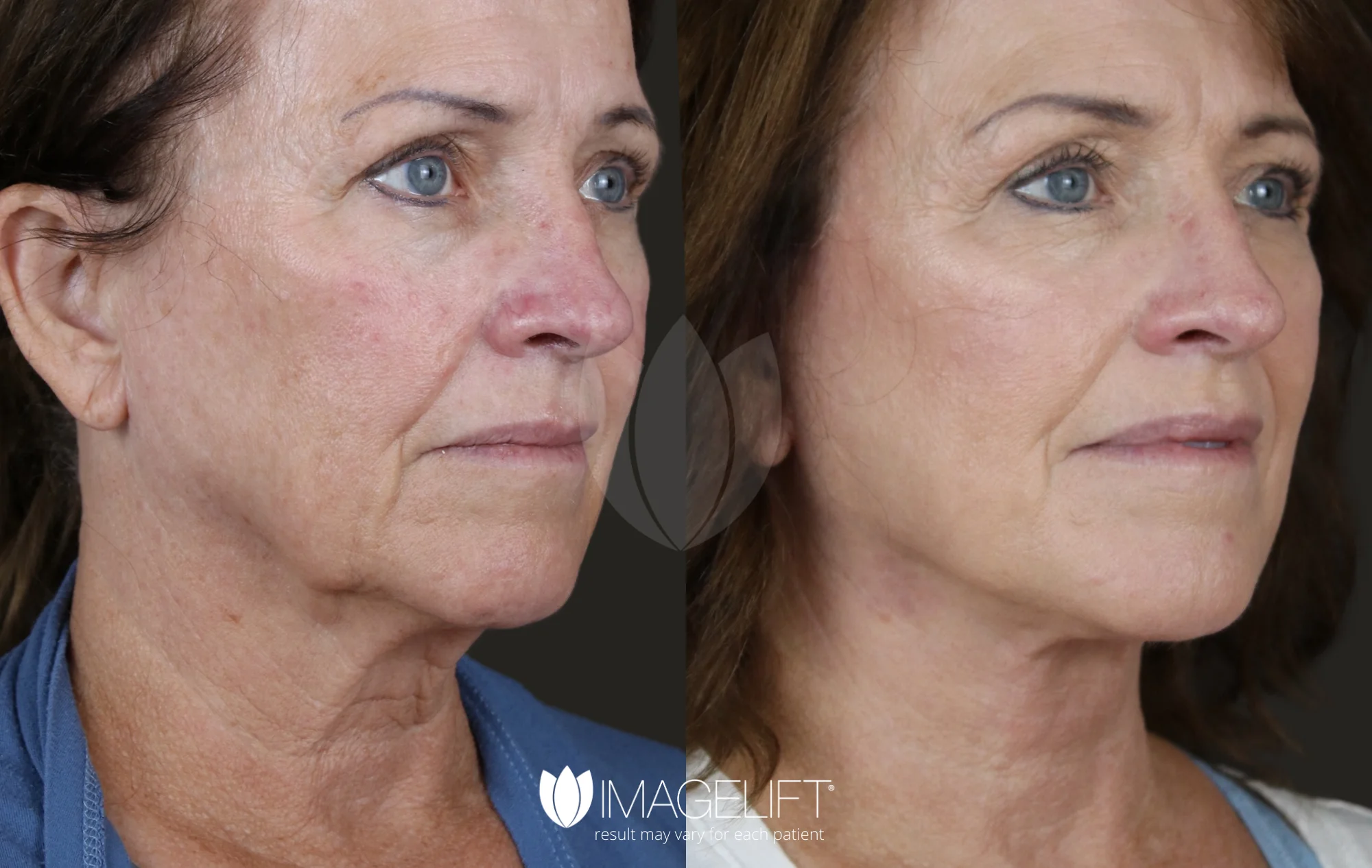 ImageLift Patient 18