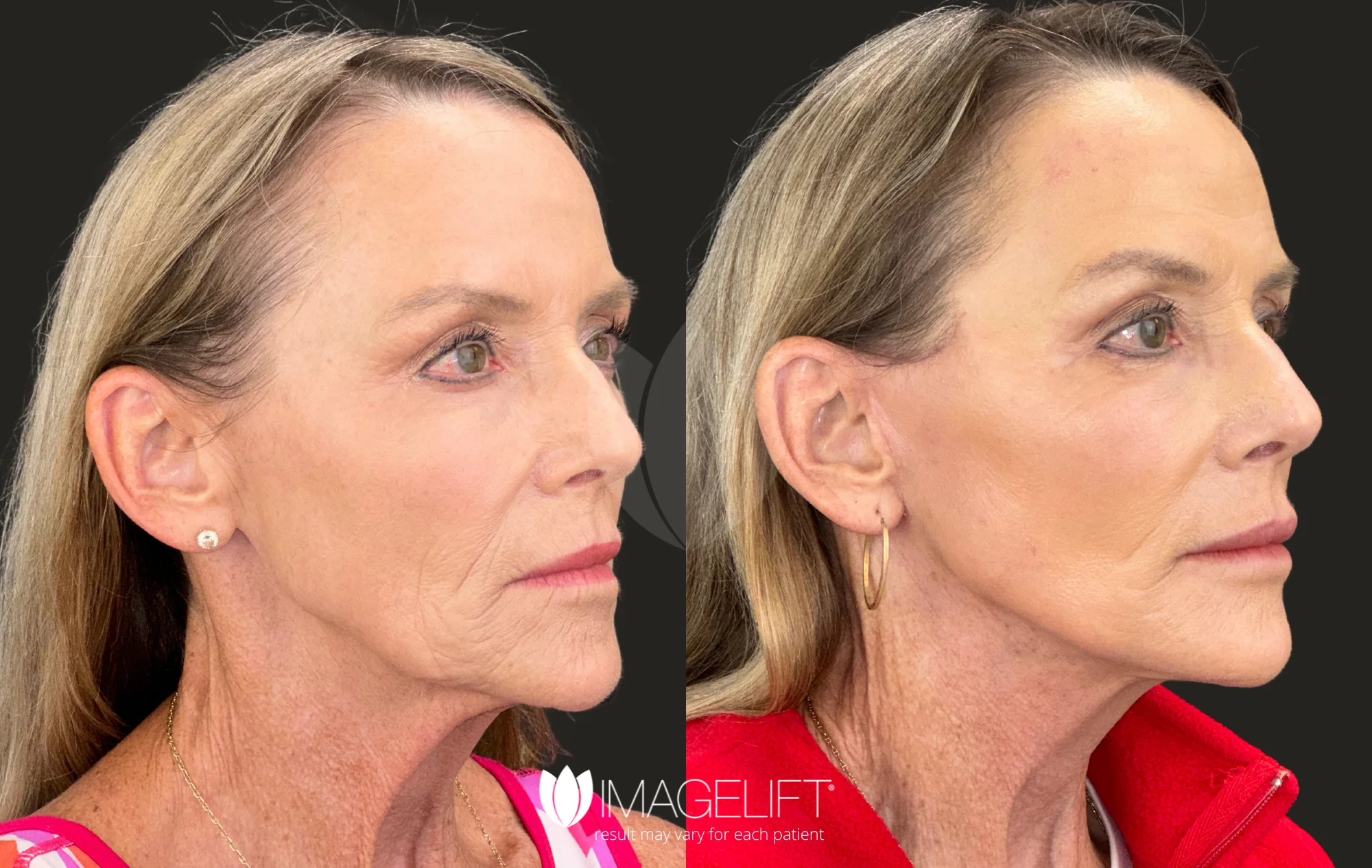 ImageLift Patient 17