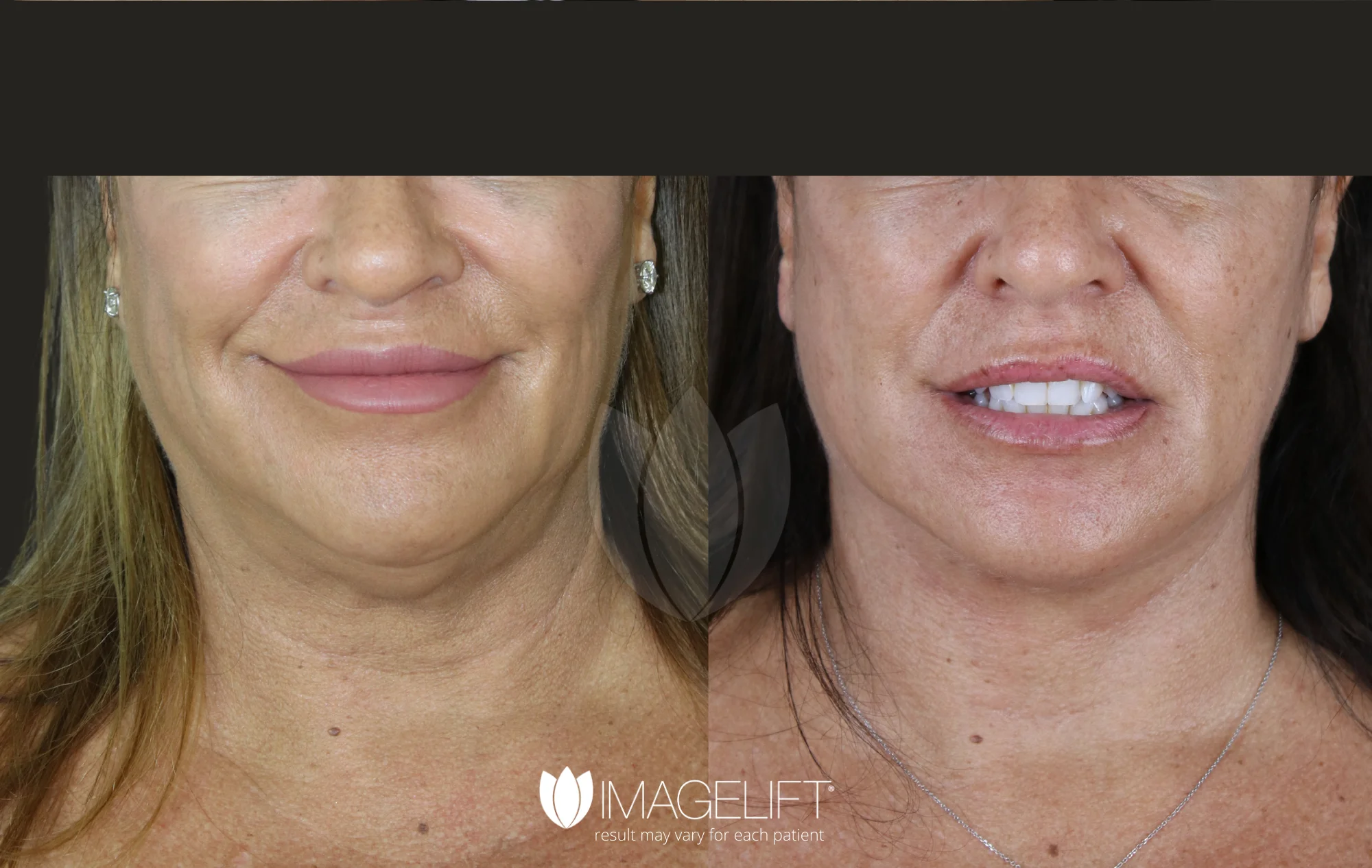 ImageLift Patient 15