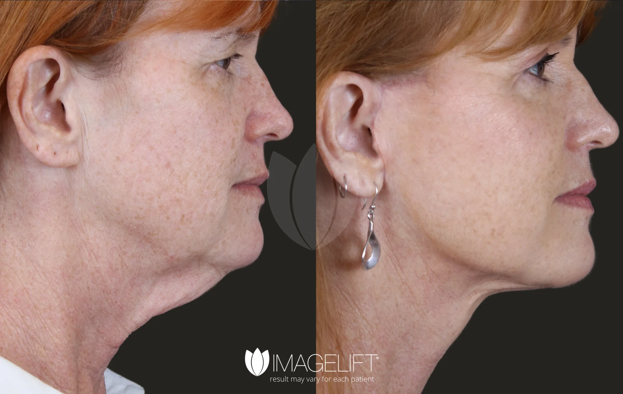 ImageLift Patient 13