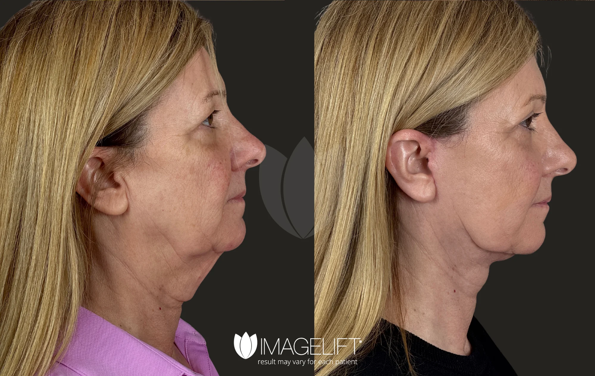 ImageLift Patient 11