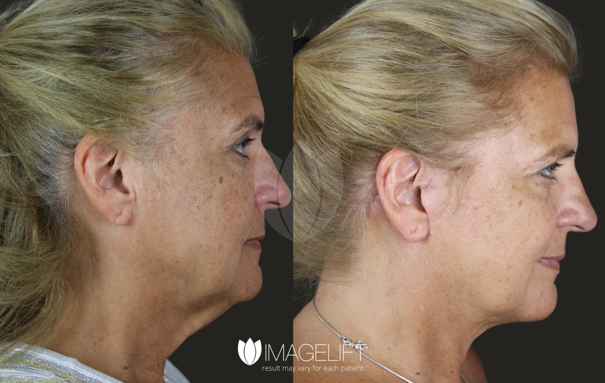 ImageLift Patient 20