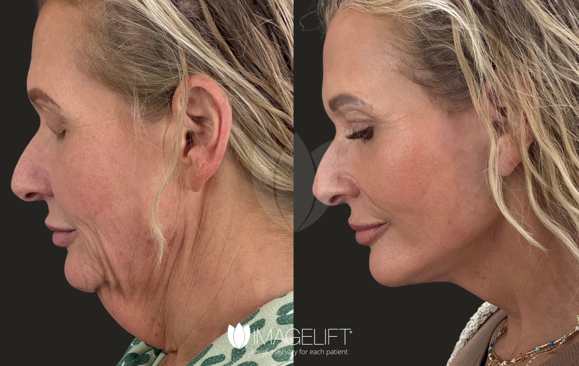 ImageLift Patient 19