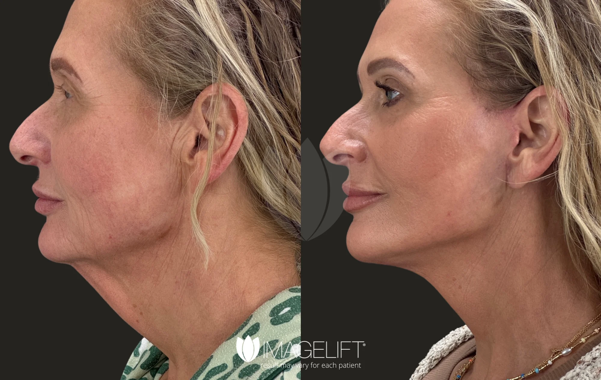 ImageLift Patient 19