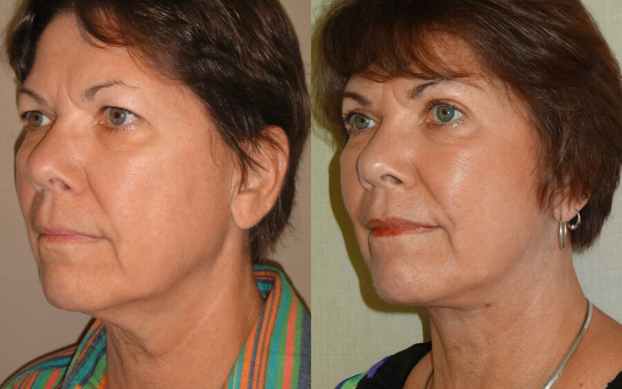 Image Lift Facelift Patient 07 | Dr. Castellano ImageLift Plastic …