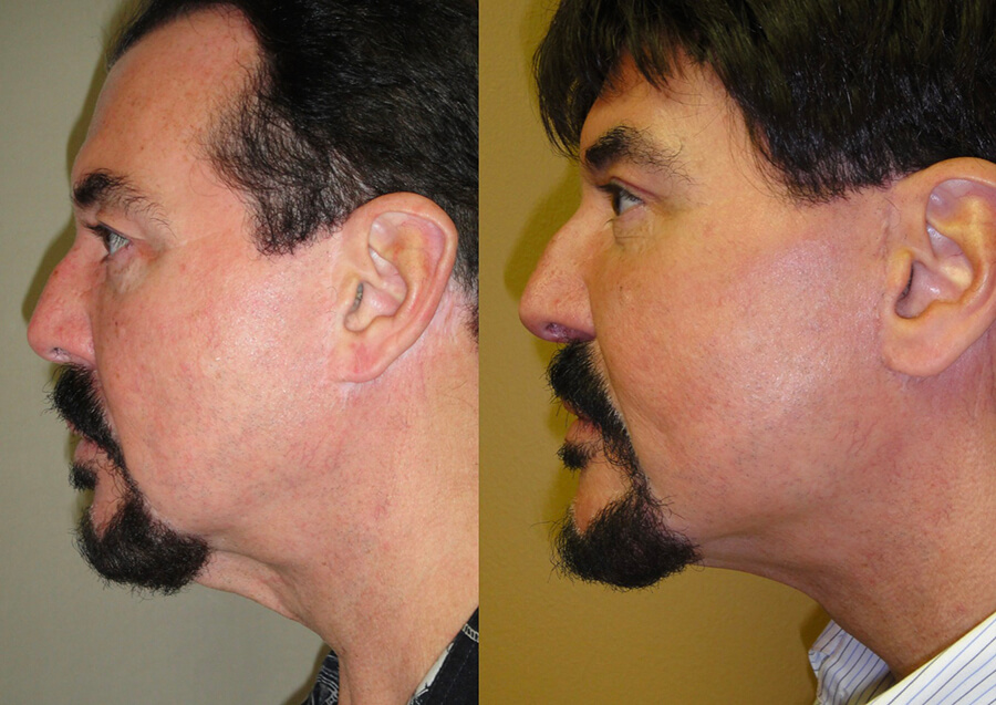 Image Lift Facelift Patient 29 | Dr. Castellano ImageLift Plastic …