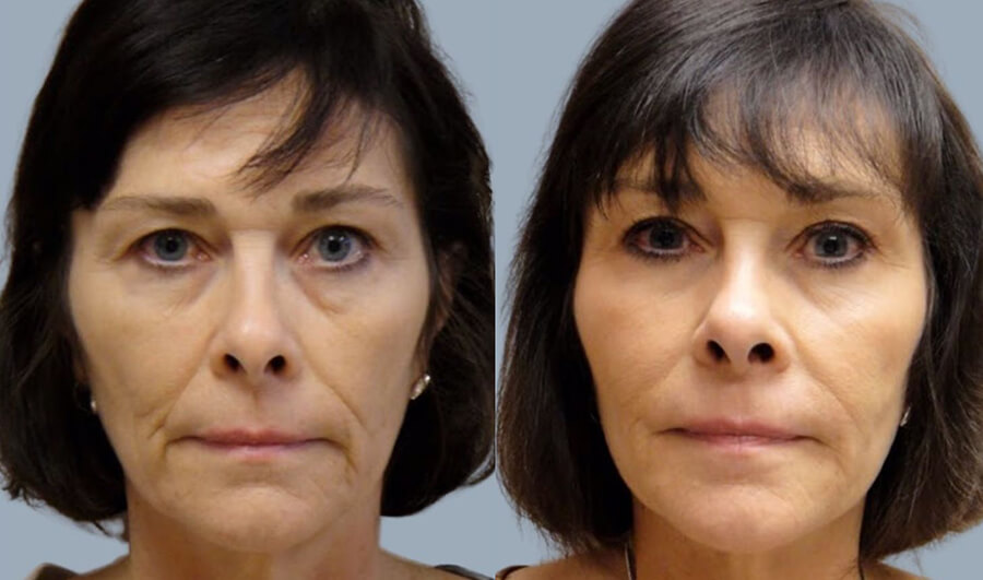 Facial Fillers Patient 06 | Dr. Castellano Imagelift Plastic Surgery Tampa